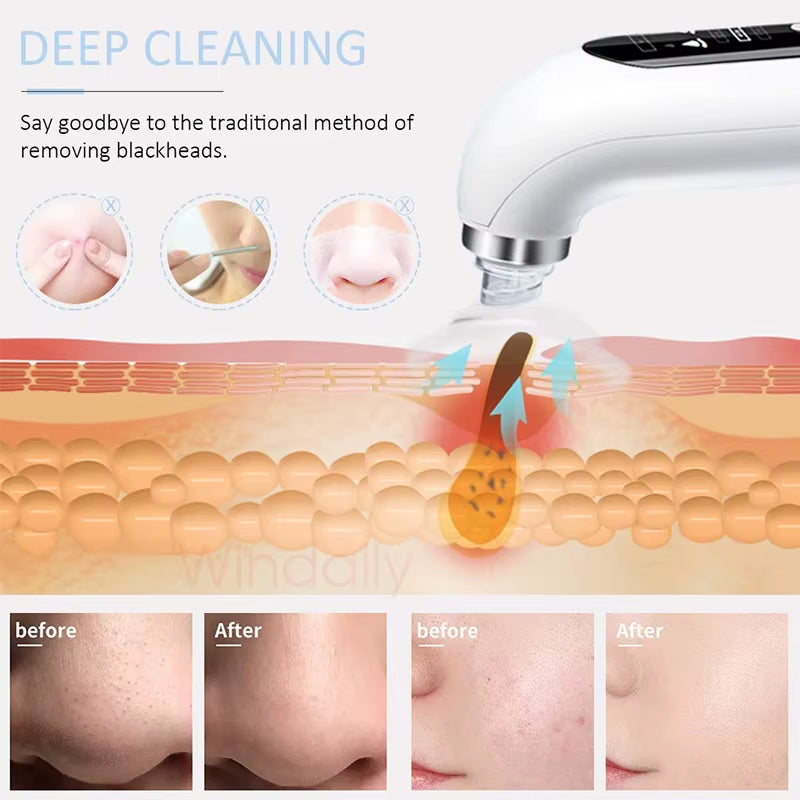 2026 Blackhead Remover Pore Vacuum Cleaner Electric Micro Small Bubble Facial Cleasing Machine USB Rechargeable Beauty Device